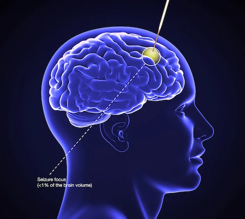 Epilepsy Drug Delivery With Smartflow.480x0 Is.Jpg